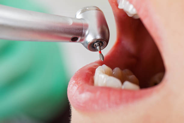 Best Emergency Tooth Extraction in Mountain Brook, AL